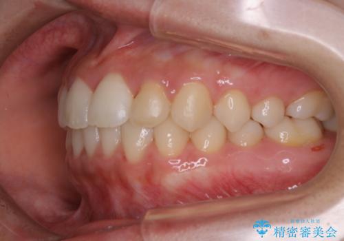 矯正治療終了後にPMTC(Professional Mechanical Tooth Cleaning)の治療後