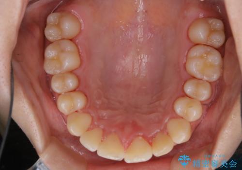 矯正治療終了後にPMTC(Professional Mechanical Tooth Cleaning)の治療後