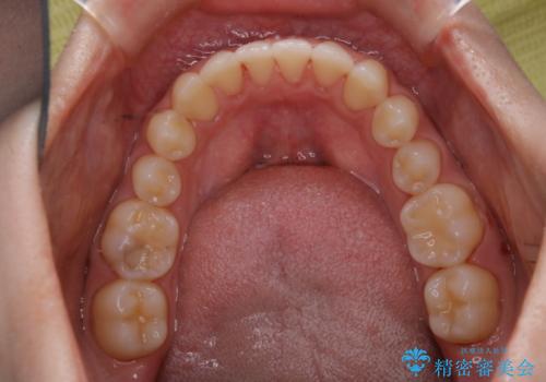 矯正治療終了後にPMTC(Professional Mechanical Tooth Cleaning)の治療後
