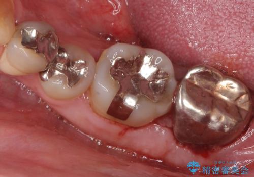 歯周病を治す 再生療法 50代男性の治療前