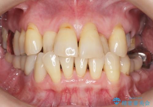 奥歯の違和感 再根管治療 40代女性の治療中