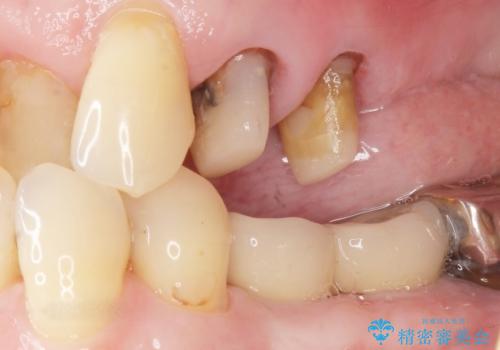 奥歯の違和感 再根管治療 40代女性の治療中