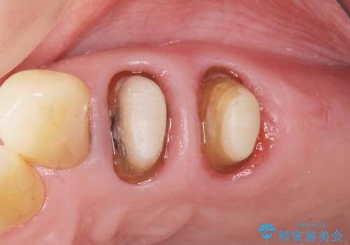 奥歯の違和感 再根管治療 40代女性の治療中