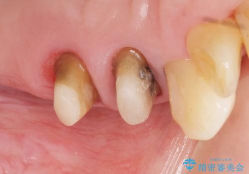 奥歯の違和感 再根管治療 40代女性の治療中