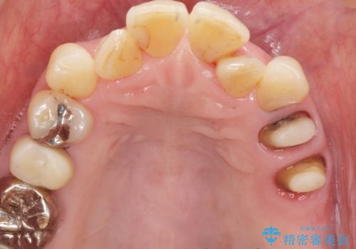 奥歯の違和感 再根管治療 40代女性の治療中