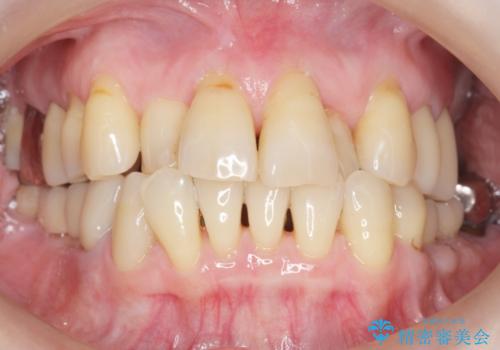 奥歯の違和感 再根管治療 40代女性の治療後