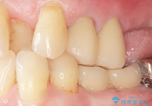 奥歯の違和感 再根管治療 40代女性の症例 治療後