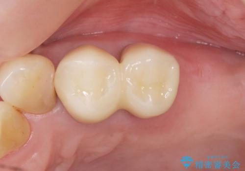 奥歯の違和感 再根管治療 40代女性の治療後