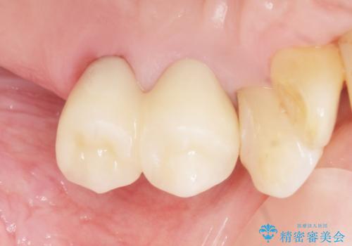 奥歯の違和感　再根管治療　40代女性の治療後