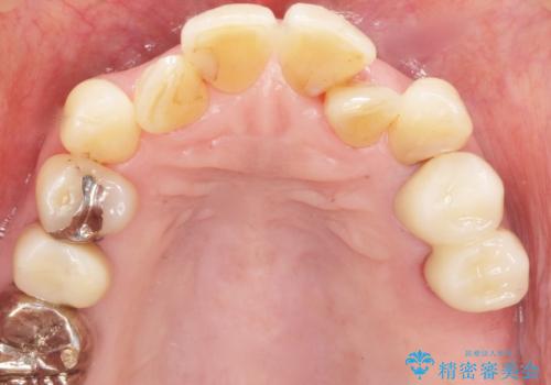 奥歯の違和感 再根管治療 40代女性の治療後