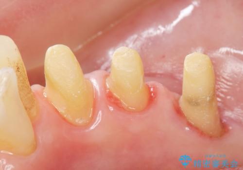 歯の動揺が気になる 低予算ではやく治したい 50代女性の治療中