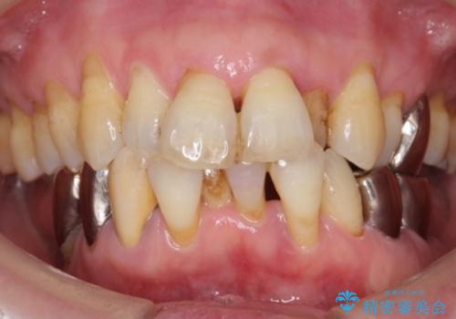 歯の動揺が気になる 低予算ではやく治したい 50代女性の治療前