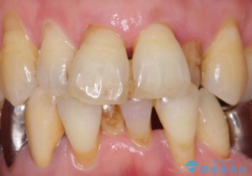 歯の動揺が気になる 低予算ではやく治したい 50代女性の治療前