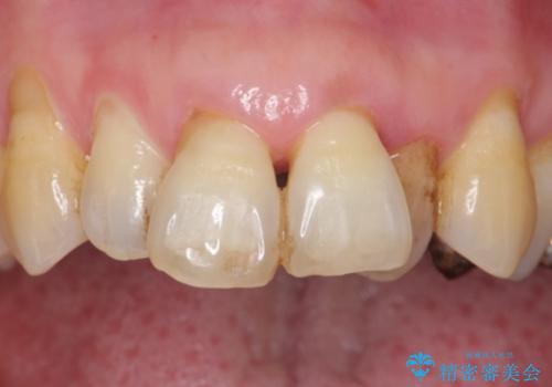 歯の動揺が気になる 低予算ではやく治したい 50代女性の治療前