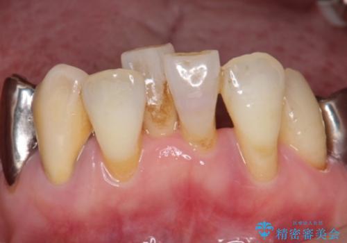 歯の動揺が気になる 低予算ではやく治したい 50代女性の治療前