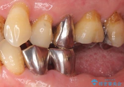 歯の動揺が気になる 低予算ではやく治したい 50代女性の治療前