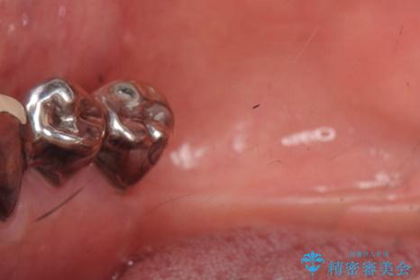 歯の動揺が気になる 低予算ではやく治したい 50代女性の治療前