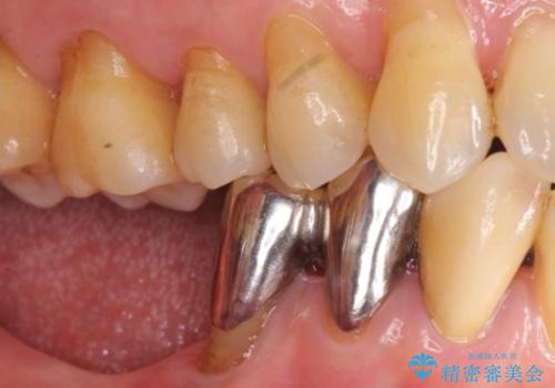 歯の動揺が気になる 低予算ではやく治したい 50代女性の治療前