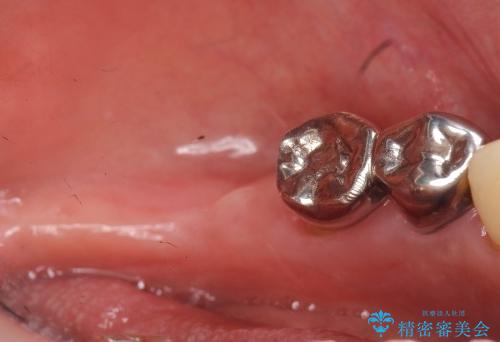 歯の動揺が気になる 低予算ではやく治したい 50代女性の治療前