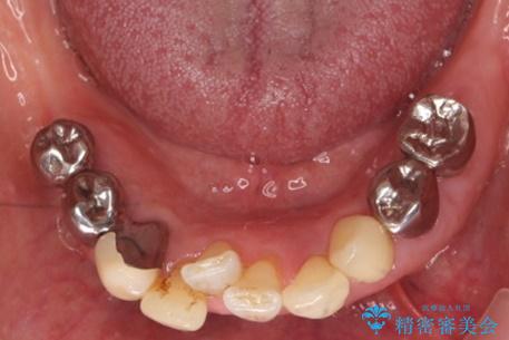 歯の動揺が気になる 低予算ではやく治したい 50代女性の治療前