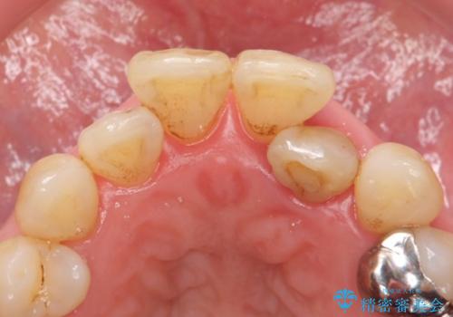 歯の動揺が気になる 低予算ではやく治したい 50代女性の治療前