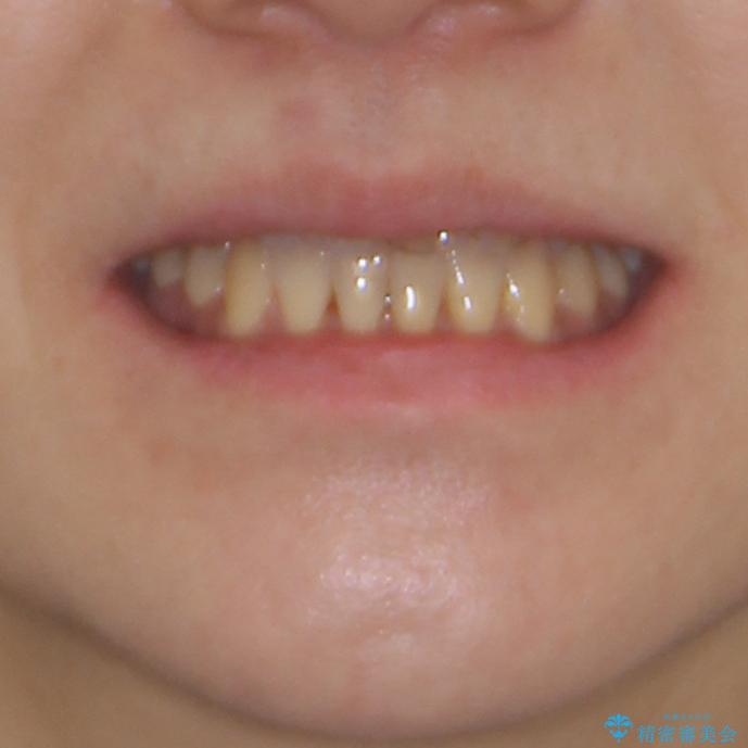 反対咬合で痛む前歯を改善　インビザラインによる矯正治療の治療後（顔貌）