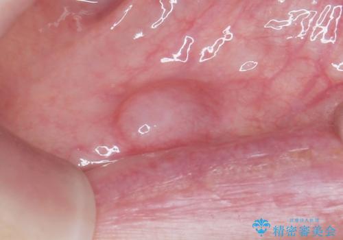 口の中のできものが大きくなってきた　粘液嚢胞の摘出　40代女性の治療前