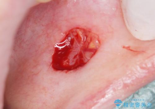 口の中のできものが大きくなってきた 粘液嚢胞の摘出 40代女性の治療中