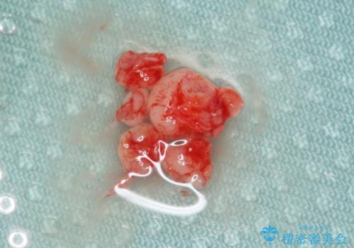 口の中のできものが大きくなってきた　粘液嚢胞の摘出　40代女性の治療中