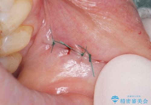 口の中のできものが大きくなってきた　粘液嚢胞の摘出　40代女性の治療後