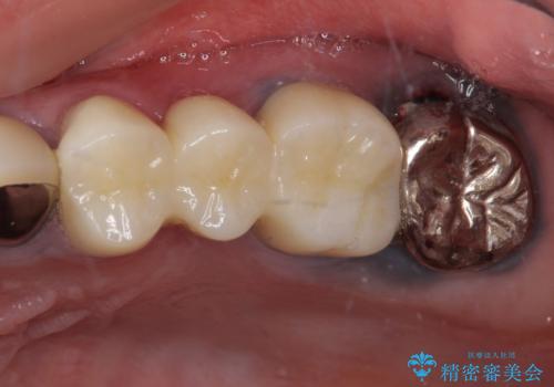 目立つ銀色の奥歯をセラミックに　セラミックブリッジの症例 治療後