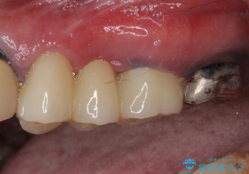 目立つ銀色の奥歯をセラミックに セラミックブリッジの治療後