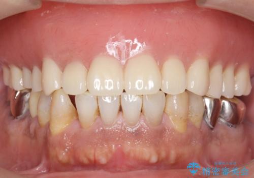 交通事故で前歯が折れた マグネットデンチャー 50代男性の症例 治療後