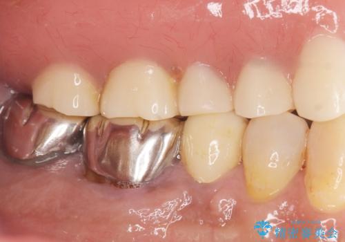 交通事故で前歯が折れた マグネットデンチャー 50代男性の治療後