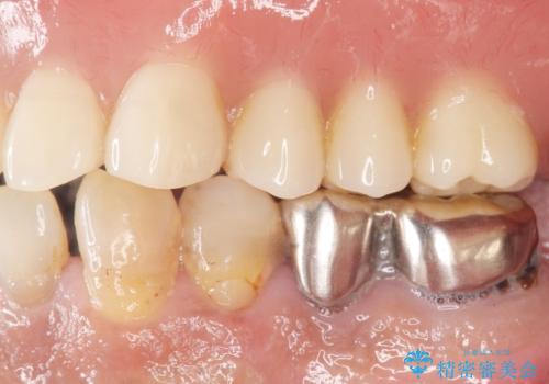 交通事故で前歯が折れた マグネットデンチャー 50代男性の治療後