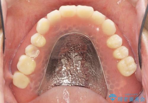 交通事故で前歯が折れた マグネットデンチャー 50代男性の治療後