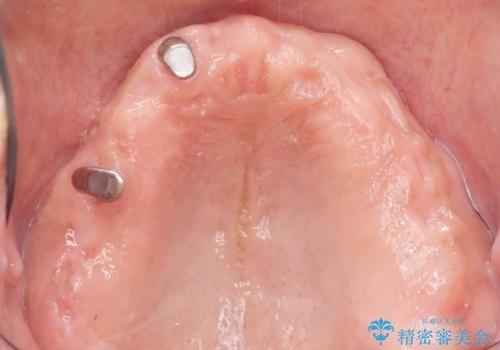 交通事故で前歯が折れた マグネットデンチャー 50代男性の治療中