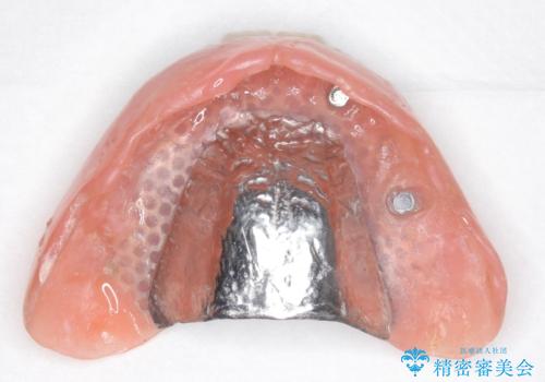 交通事故で前歯が折れた マグネットデンチャー 50代男性の治療中