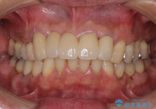 話しにくく見栄えの悪い前歯 オールセラミックブリッジの治療後
