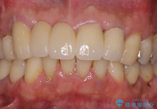 話しにくく見栄えの悪い前歯 オールセラミックブリッジの治療後