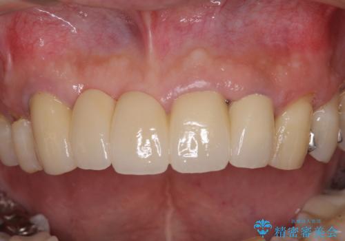 話しにくく見栄えの悪い前歯 オールセラミックブリッジの治療後