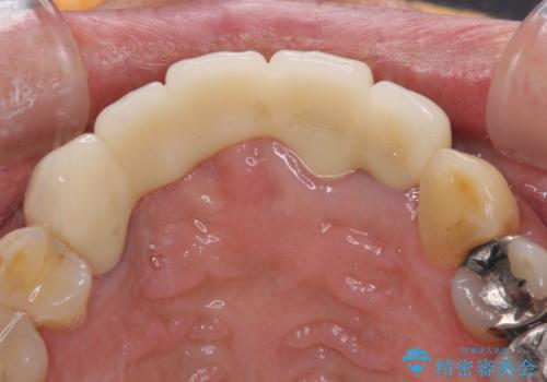 話しにくく見栄えの悪い前歯 オールセラミックブリッジの治療後