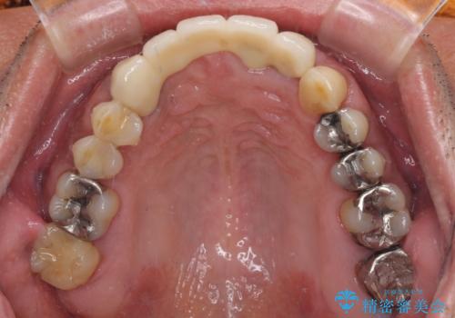 話しにくく見栄えの悪い前歯 オールセラミックブリッジの治療後