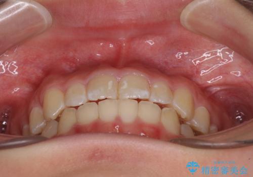 遠方から新幹線で通院 急速拡大装置とインビザラインによる矯正治療の治療後