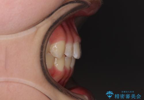 遠方から新幹線で通院 急速拡大装置とインビザラインによる矯正治療の治療後