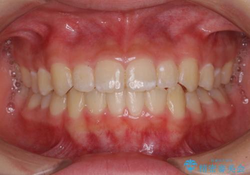 遠方から新幹線で通院 急速拡大装置とインビザラインによる矯正治療の治療後