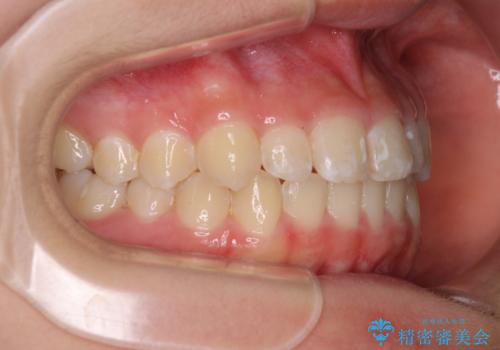 遠方から新幹線で通院 急速拡大装置とインビザラインによる矯正治療の治療後