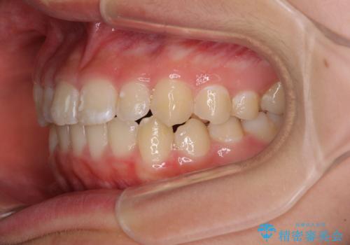 遠方から新幹線で通院 急速拡大装置とインビザラインによる矯正治療の治療後