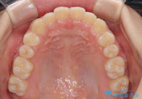 遠方から新幹線で通院 急速拡大装置とインビザラインによる矯正治療の治療後