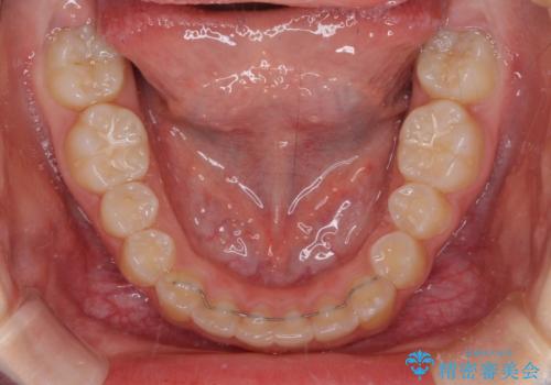 遠方から新幹線で通院 急速拡大装置とインビザラインによる矯正治療の治療後